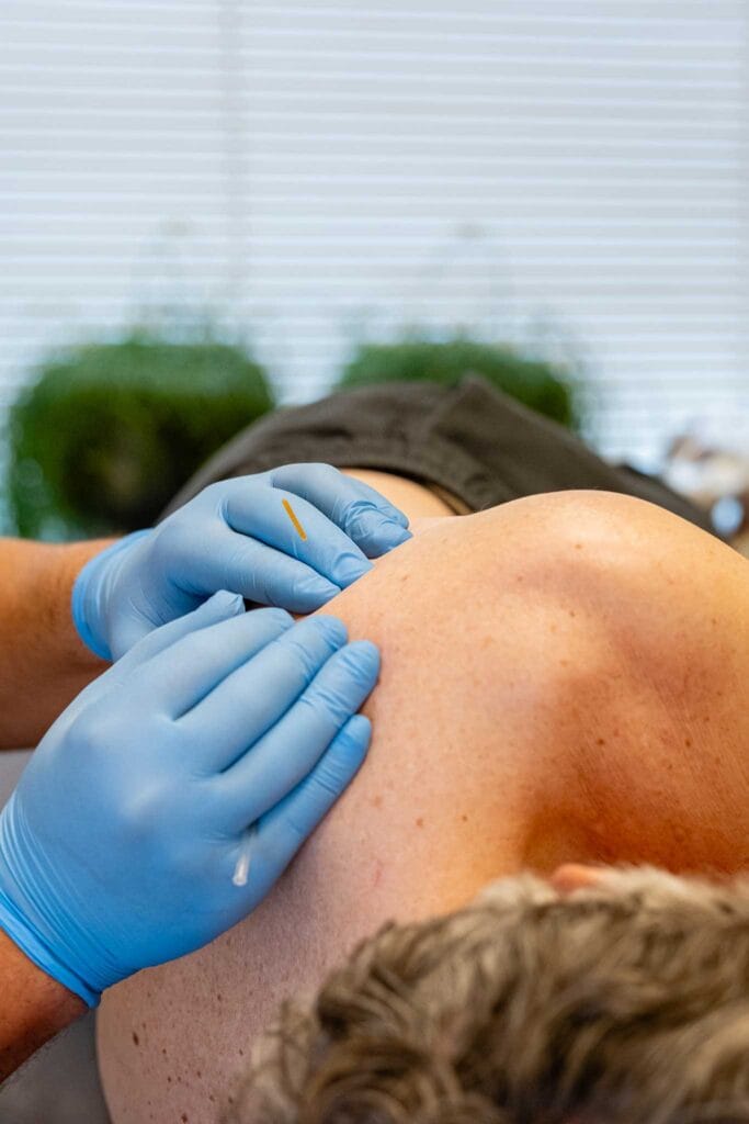 Dry Needling De Rooy Fysio